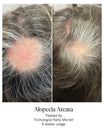 Calecim Advanced Hair System Kit